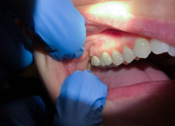 Best Emergency Treatment for Dental Infections or Abscesses in Belle Rose, LA