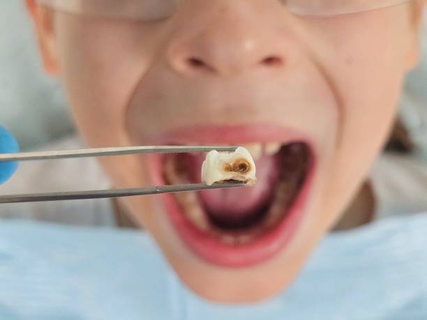 Best Urgent Care for Lost Fillings or Crowns in Belle Rose, LA